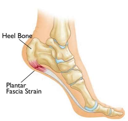 Planter Fasciitis