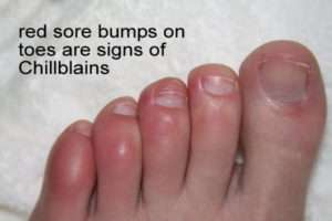 What are Foot Chilblains