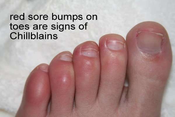 What are Foot Chilblains