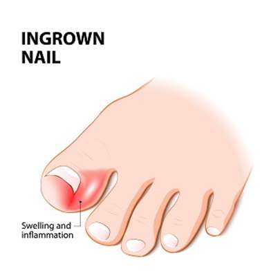 ingrown nails