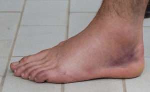 Ankle Sprained and swollen