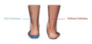What is an orthotic