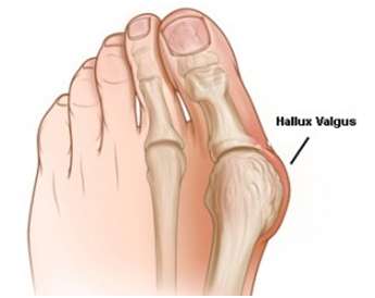 bunions or hallux valgus