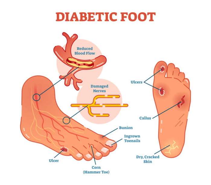 diabetes and your feet