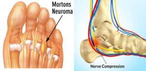 foot nerve entrapment