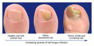 fungal nail infections