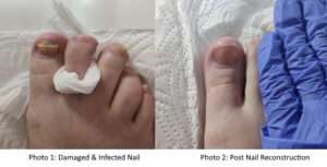What is nail reconstruction