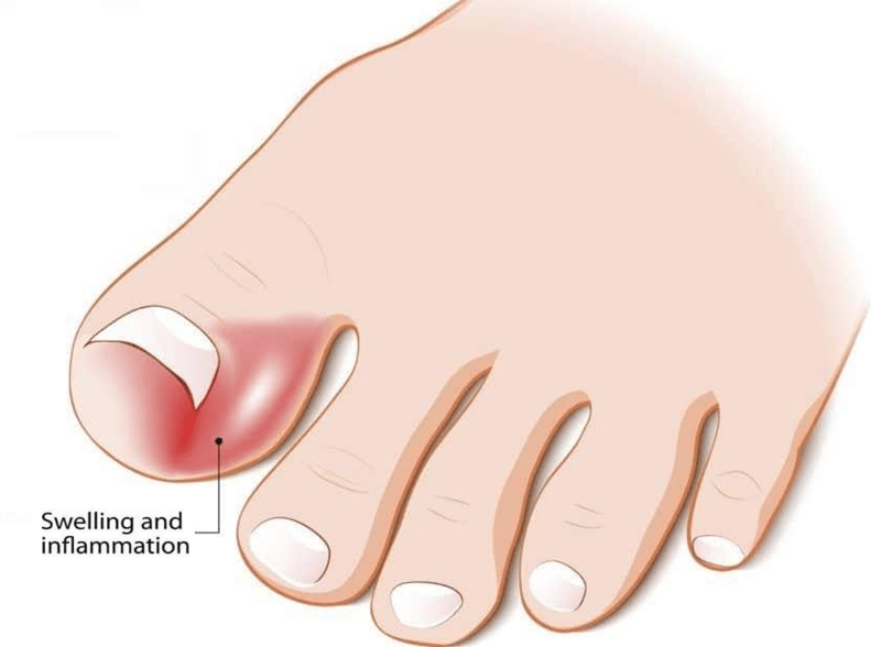 Ingrown Toenail Treatment  Bishopstown Podiatry Clinic