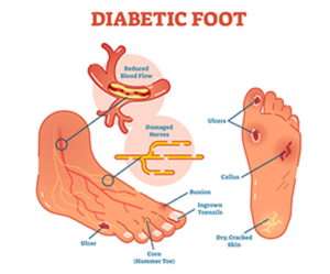 Diabetic Foot